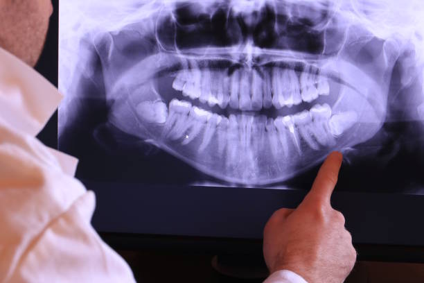 Best Emergency Tooth Extraction in Otsego, MI
